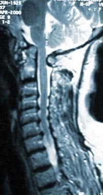 Rheumatoid spondylitis. MRI of a patient with supe