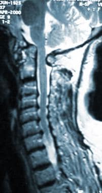 Cervical Spondylosis  Johns Hopkins Medicine