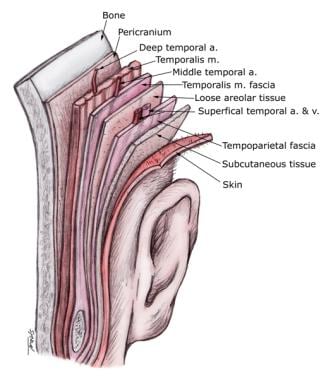 Temporoparietal fascia flap. A more accurate descr
