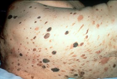 Macular benign skin lesions: Seborrheic keratoses 
