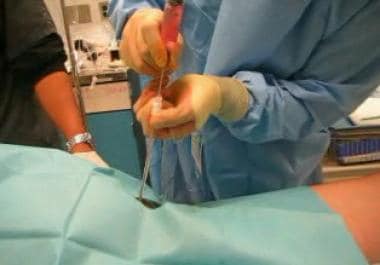 Advancing the catheter over the needle. 