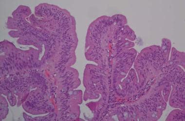 villous adenoma histology