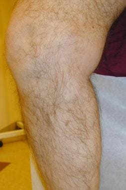 Varicose Vein Treatment With Endovenous Laser Therapy: Overview,  Indications, Contraindications