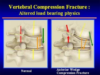 Once an anterior wedge compression fracture has oc