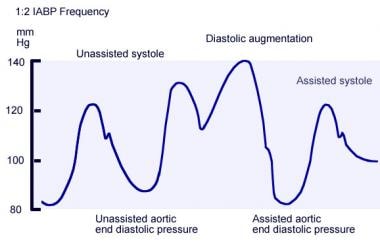 Annotated arterial pressure tracing obtained from 
