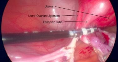 Ooforoplastia e salpingectomia laparoscópica / Oophoroplasty and  laparoscopic salpingectomy (left). 