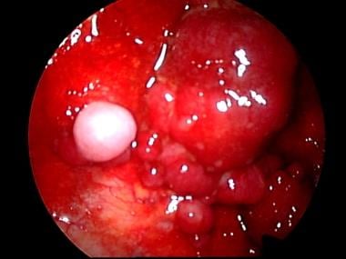 Bulky metastasis on parietal pleura. 