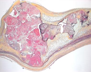 Aortic Stenosis Pathology. Histologic section from