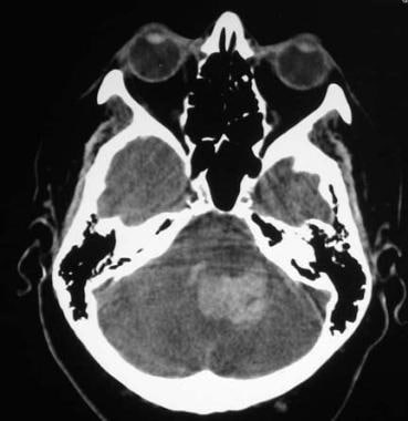 Arteriovenous malformation (AVM) of the brain. CT 