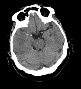 Dense middle cerebral artery (MCA) sign: Noncontra