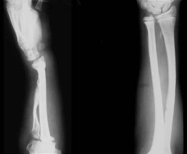 (Left) Plain radiograph of the left forearm in a 1
