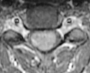 Axial T1-weighted image demonstrates a homogeneous