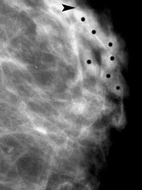 Breast cancer, ultrasonography. This mediolateral 