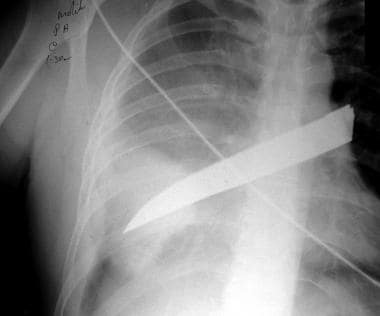 Supine chest radiograph in a man who was stabbed. 