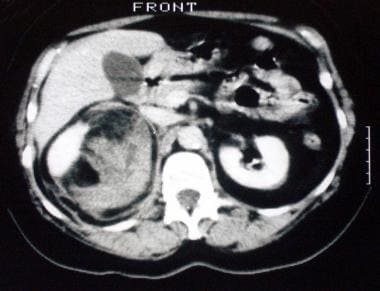 Contrast-enhanced axial computed tomography scan o