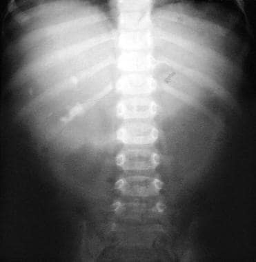 Plain abdominal radiograph in a 3-year-old child. 