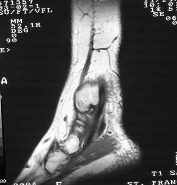 Ankle, tibialis posterior tendon injuries. Sagitta