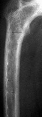Anteroposterior radiograph of the proximal femur i