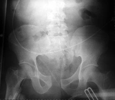 The anteroposterior pelvis radiograph quickly help