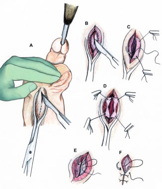 Technique of perineal urethrostomy. Incision is ma