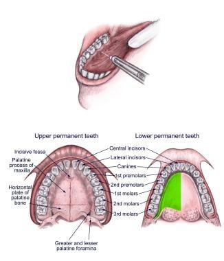 lingual paresthesia from nerve injection