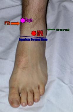 Areas of anesthetization to complete an ankle bloc