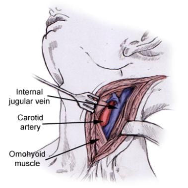 Sternocleidomastoid muscle is retracted posteriorl