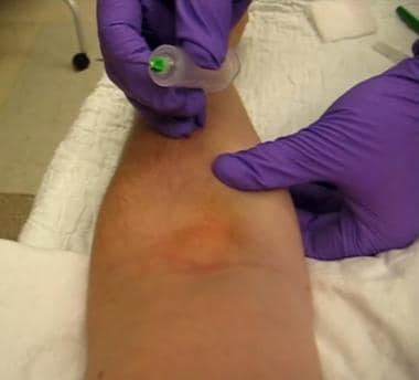 Phlebotomy. Application of traction.