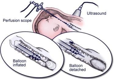 Schematic of fetal tracheal balloon occlusion, usi