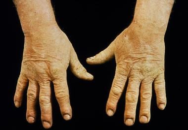 contact dermatitis fingers