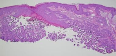 Warty dyskeratoma. An endo-exophytic squamous prol