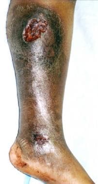 Typical chronic medial leg ulceration associated w