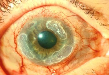 Peripheral ulcerative keratitis in the right eye o