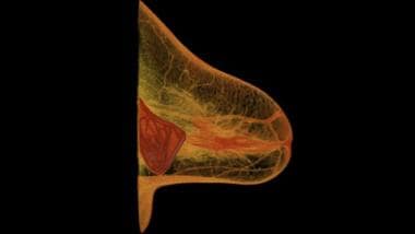 A computed tomography (CT) scan reveals a breast i