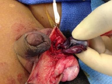 Intravaginal torsion in a child. 