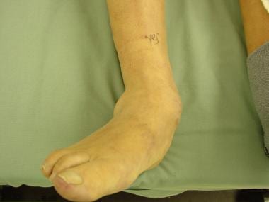Clinical view of valgus foot deformity with abduct