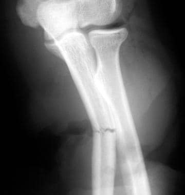 long arm splint radial head fracture