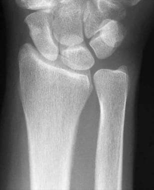 Posteroanterior radiograph of normal wrist. 