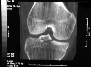 tibial intercondylar eminence