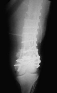 Supracondylar femur fracture treated with a cobra 