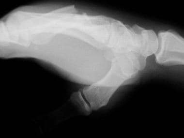 Displaced fourth and fifth metacarpal fractures, l