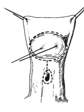 Distal hypospadias. A traction suture is placed th