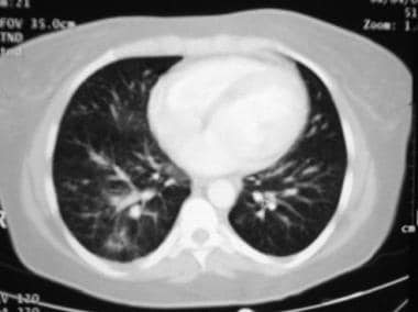 Dyspnea: NICE TA-TA'S