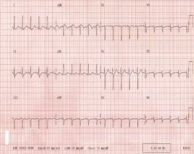 Sinus tachycardia. Note that the QRS complexes are