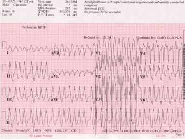 Antidromic Wpw 12 Lead Ekg