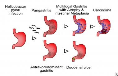 Atrophic gastritis. Schematic representation of He