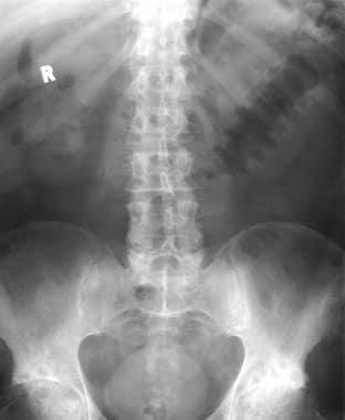 Toxic Megacolon. Plain abdominal radiograph from a