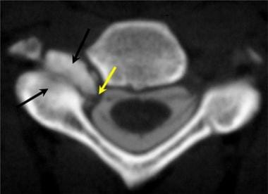 Axial cervical CT myelogram demonstrates marked hy