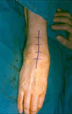 Universal incision of the wrist. 