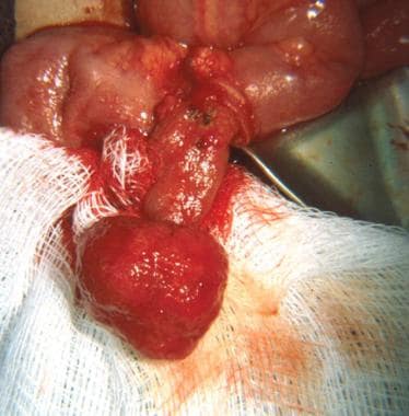 Intraoperative view of a bleeding juvenile polyp. 